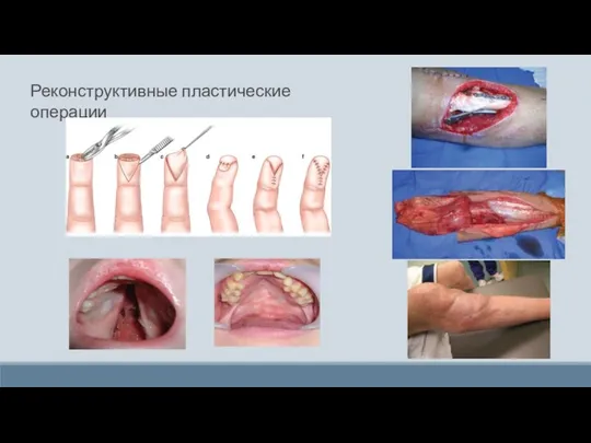 Реконструктивные пластические операции