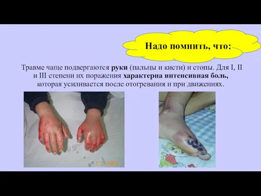 Травме чаще подвергаются руки (пальцы и кисти) и стопы. Для I,