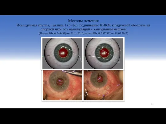 Методы лечения Исследуемая группа, Тактика 1 (n=26): подшивание КИКМ к радужной
