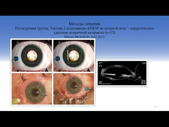 Методы лечения Исследуемая группа, Тактика 2 подшивание КИКМ на опорной игле