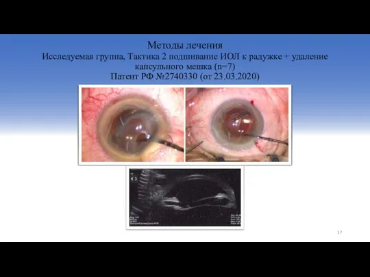Методы лечения Исследуемая группа, Тактика 2 подшивание ИОЛ к радужке +