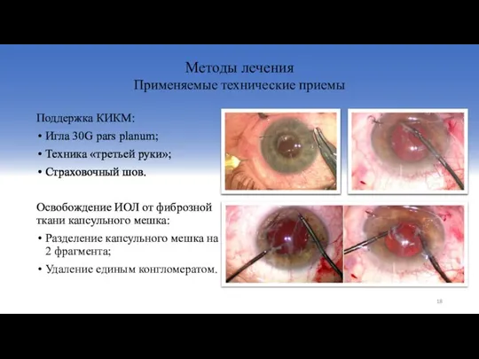 Поддержка КИКМ: Игла 30G pars planum; Техника «третьей руки»; Страховочный шов.