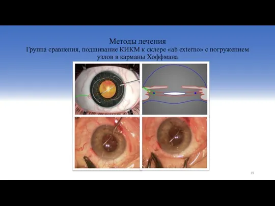 Методы лечения Группа сравнения, подшивание КИКМ к склере «ab externo» с погружением узлов в карманы Хоффмана