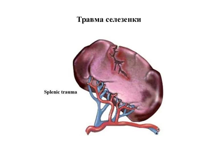 Травма селезенки