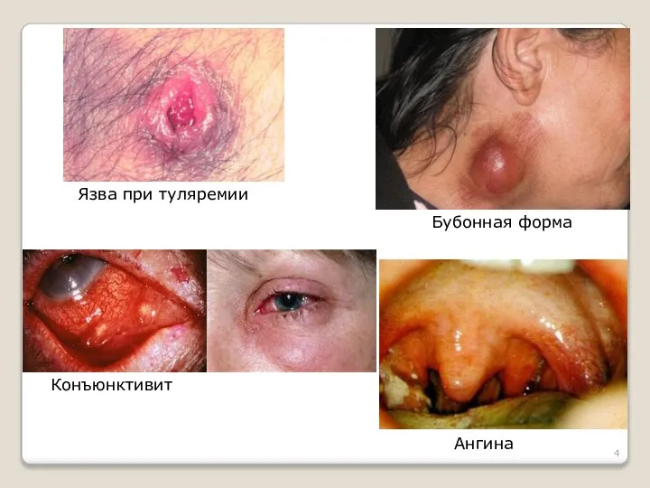 Бубонная форма Язва при туляремии Конъюнктивит Ангина