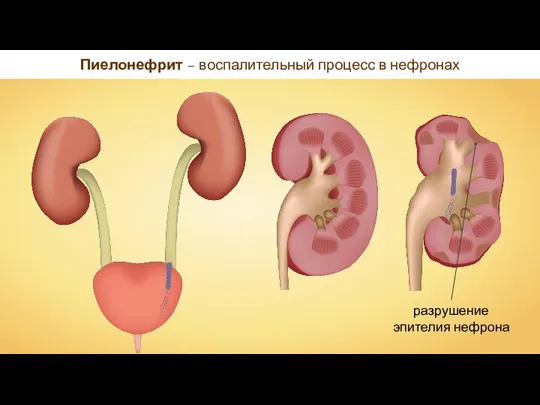 Пиелонефрит – воспалительный процесс в нефронах