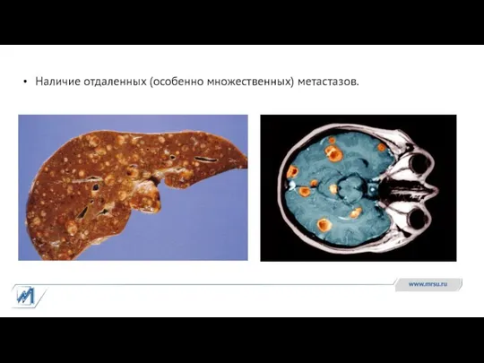 Наличие отдаленных (особенно множественных) метастазов.