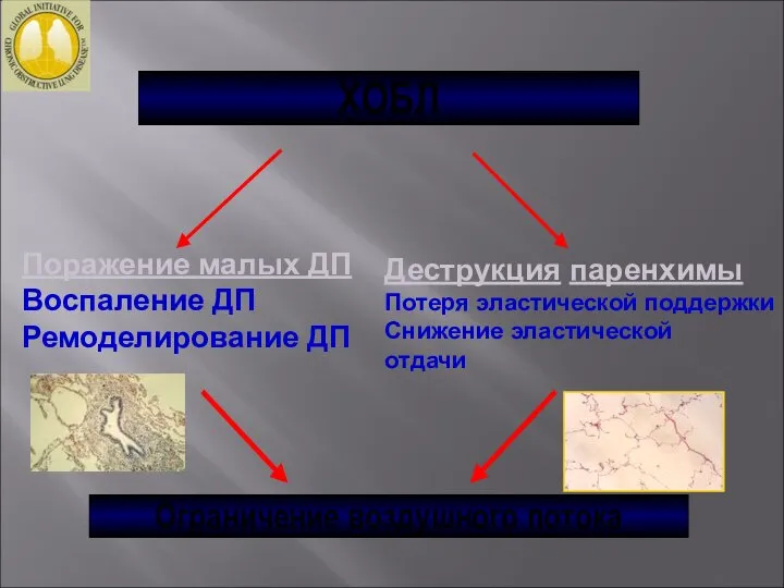 ХОБЛ Поражение малых ДП Воспаление ДП Ремоделирование ДП Деструкция паренхимы Потеря