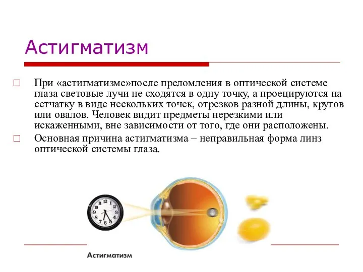 Астигматизм При «астигматизме»после преломления в оптической системе глаза световые лучи не