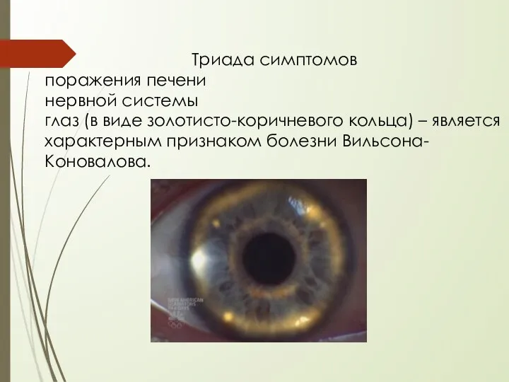 Триада симптомов поражения печени нервной системы глаз (в виде золотисто-коричневого кольца)