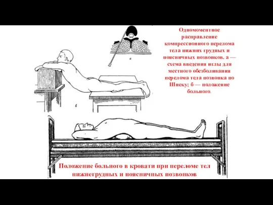 Положение больного в кровати при переломе тел нижнегрудных и поясничных позвонков