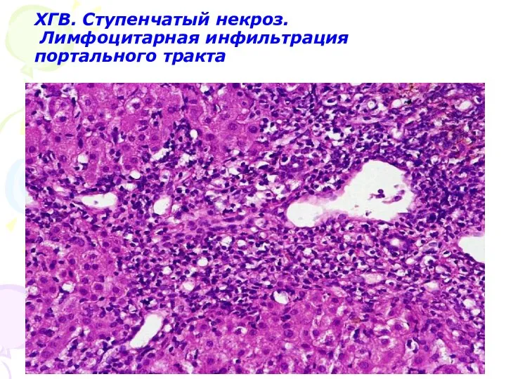 ХГВ. Ступенчатый некроз. Лимфоцитарная инфильтрация портального тракта