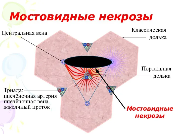 Мостовидные некрозы Триада: ппечёночная артерия ппечёночная вена жжелчный проток Центральная вена