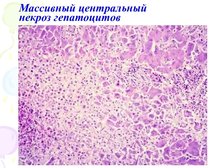 Массивный центральный некроз гепатоцитов