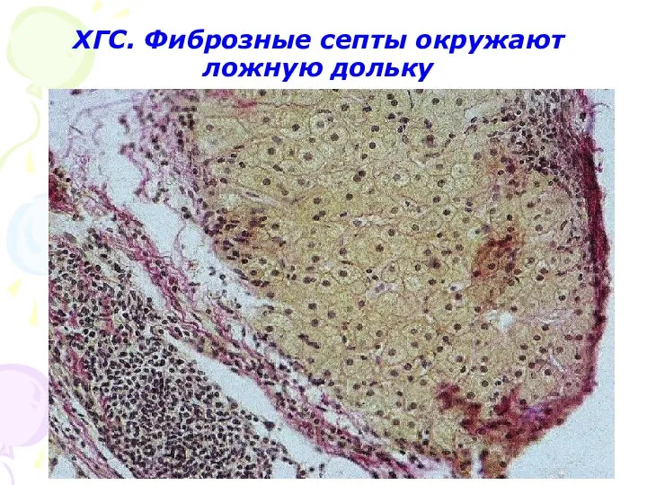 ХГС. Фиброзные септы окружают ложную дольку