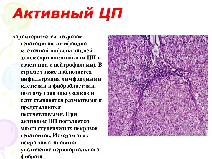 Активный ЦП характеризуется некрозом гепатоцитов, лимфоидно-клеточной инфильтрацией долек (при алкогольном ЦП