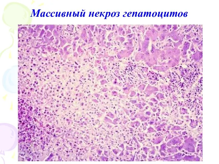 Массивный некроз гепатоцитов