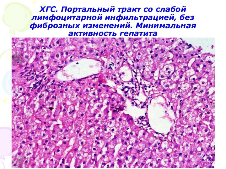 ХГС. Портальный тракт со слабой лимфоцитарной инфильтрацией, без фиброзных изменений. Минимальная активность гепатита