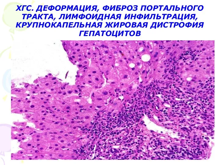 ХГС. ДЕФОРМАЦИЯ, ФИБРОЗ ПОРТАЛЬНОГО ТРАКТА, ЛИМФОИДНАЯ ИНФИЛЬТРАЦИЯ, КРУПНОКАПЕЛЬНАЯ ЖИРОВАЯ ДИСТРОФИЯ ГЕПАТОЦИТОВ