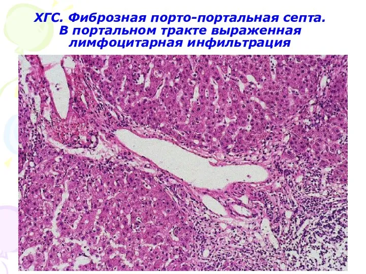 ХГС. Фиброзная порто-портальная септа. В портальном тракте выраженная лимфоцитарная инфильтрация