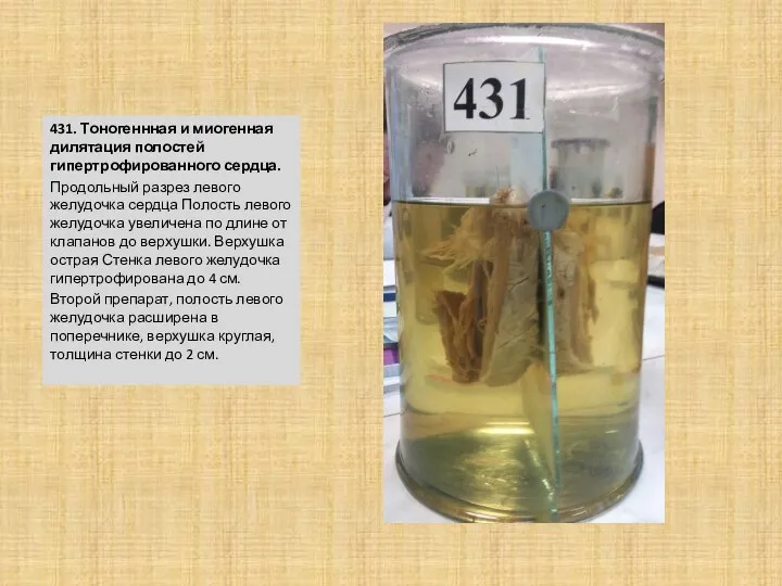 431. Тоногеннная и миогенная дилятация полостей гипертрофированного сердца. Продольный разрез левого