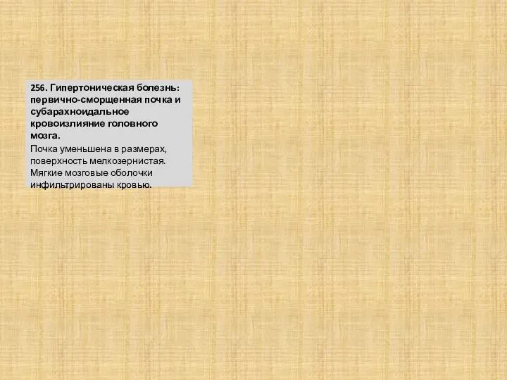 256. Гипертоническая болезнь: первично-сморщенная почка и субарахноидальное кровоизлияние головного мозга. Почка