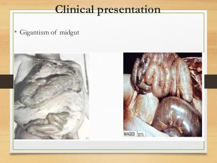 Clinical presentation Gigantism of midgut