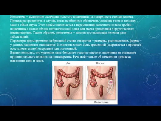 Колостома − выведение окончания толстого кишечника на поверхность стенки живота. Процедура