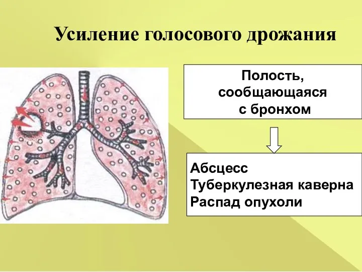 Усиление голосового дрожания Абсцесс Туберкулезная каверна Распад опухоли Полость, сообщающаяся с бронхом