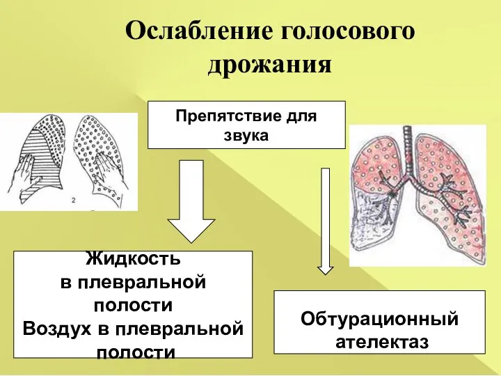 Препятствие для звука Жидкость в плевральной полости Воздух в плевральной полости Ослабление голосового дрожания Обтурационный ателектаз