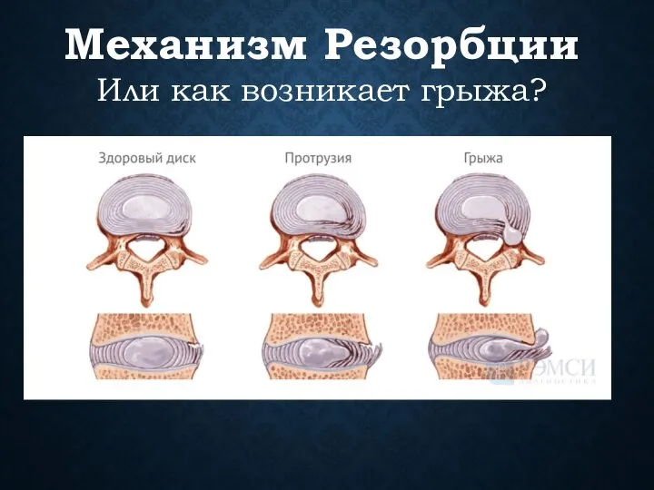 Механизм Резорбции Или как возникает грыжа?