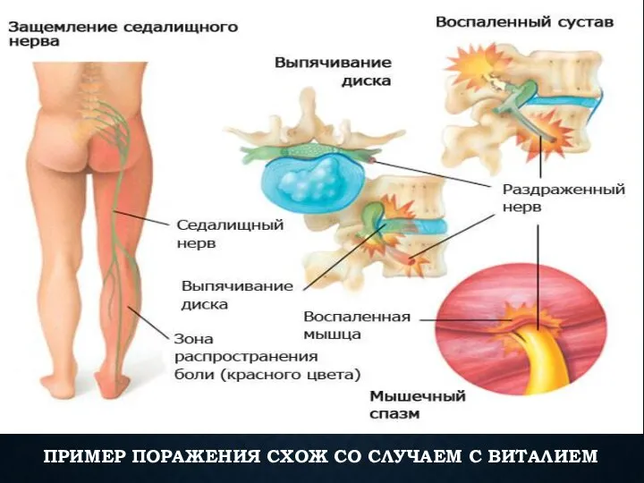 ПРИМЕР ПОРАЖЕНИЯ СХОЖ СО СЛУЧАЕМ С ВИТАЛИЕМ