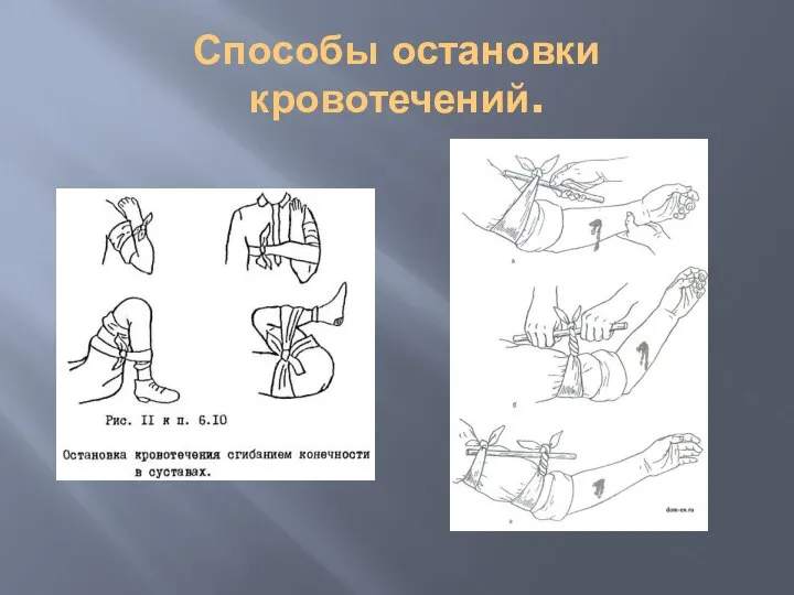 Способы остановки кровотечений.