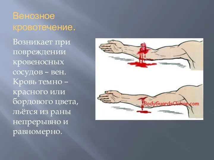 Венозное кровотечение. Возникает при повреждении кровеносных сосудов – вен. Кровь темно