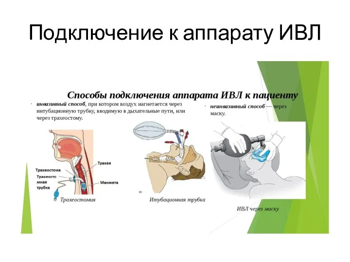 Подключение к аппарату ИВЛ