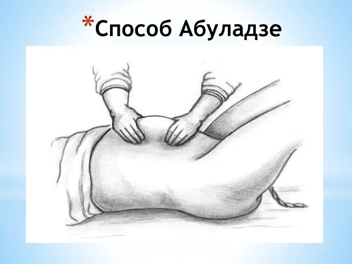 Способ Абуладзе