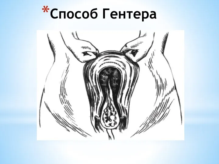 Способ Гентера