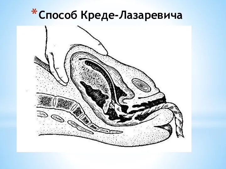 Способ Креде-Лазаревича