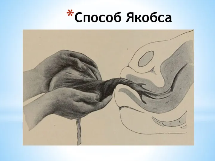 Способ Якобса