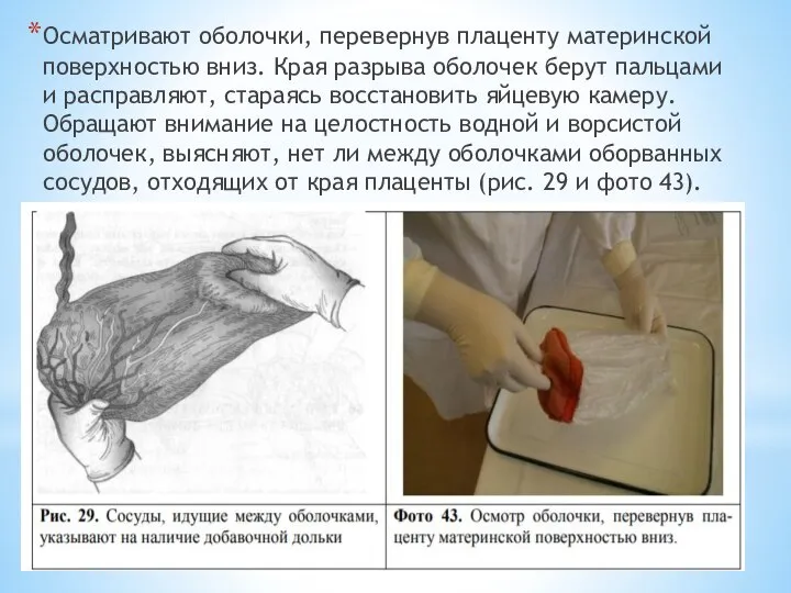 Осматривают оболочки, перевернув плаценту материнской поверхностью вниз. Края разрыва оболочек берут