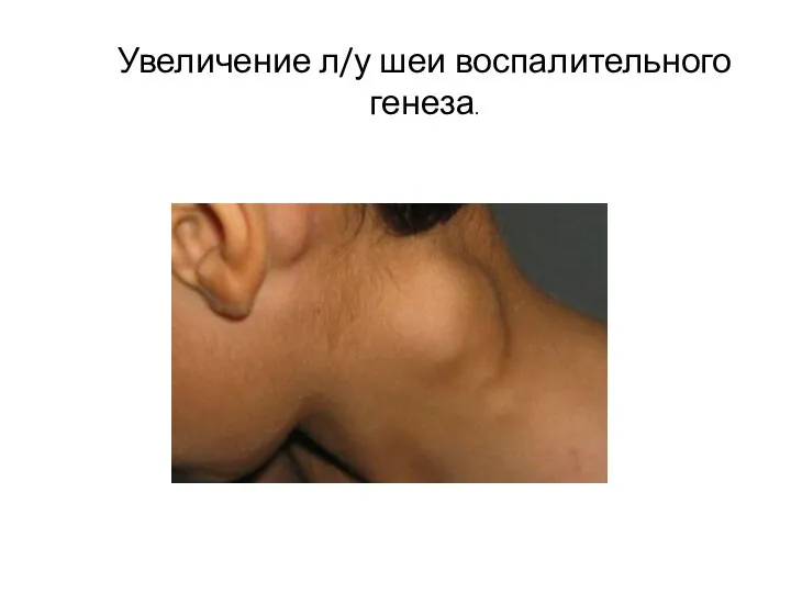 Увеличение л/у шеи воспалительного генеза.