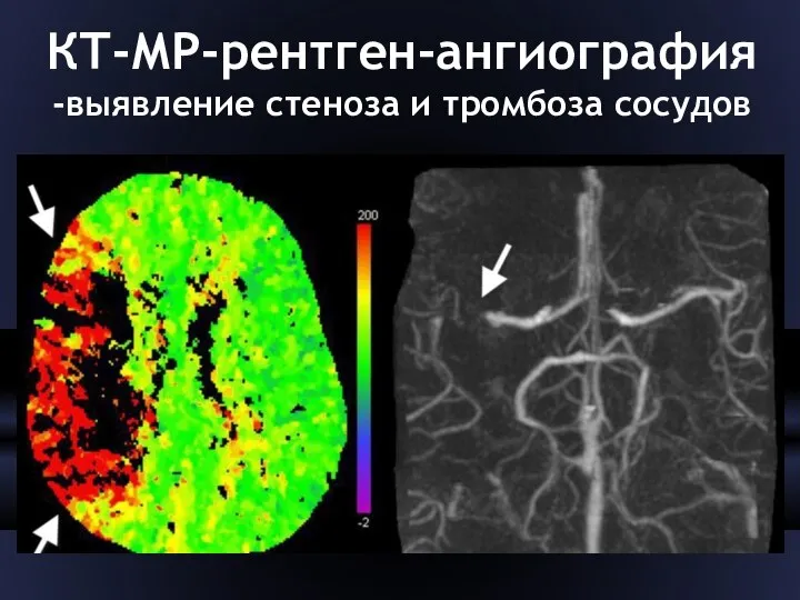 КТ-МР-рентген-ангиография -выявление стеноза и тромбоза сосудов