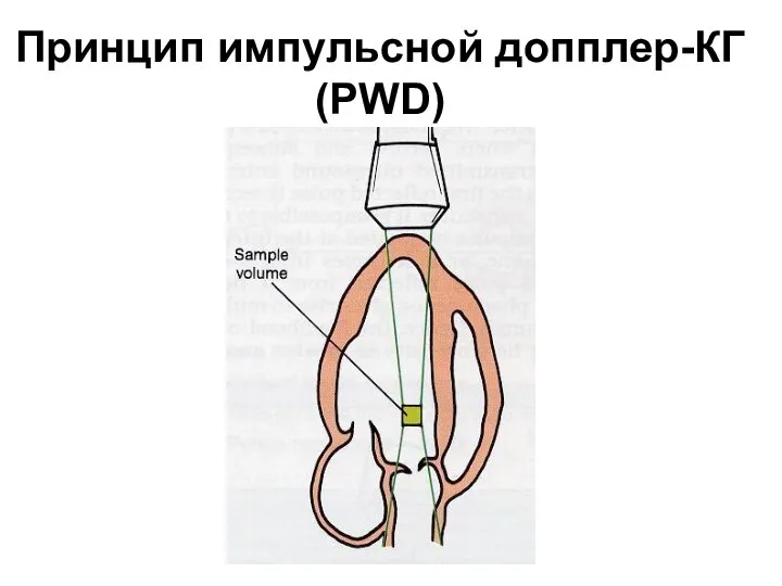 Принцип импульсной допплер-КГ (PWD)