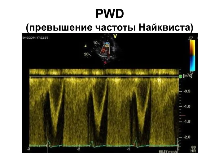 PWD (превышение частоты Найквиста)