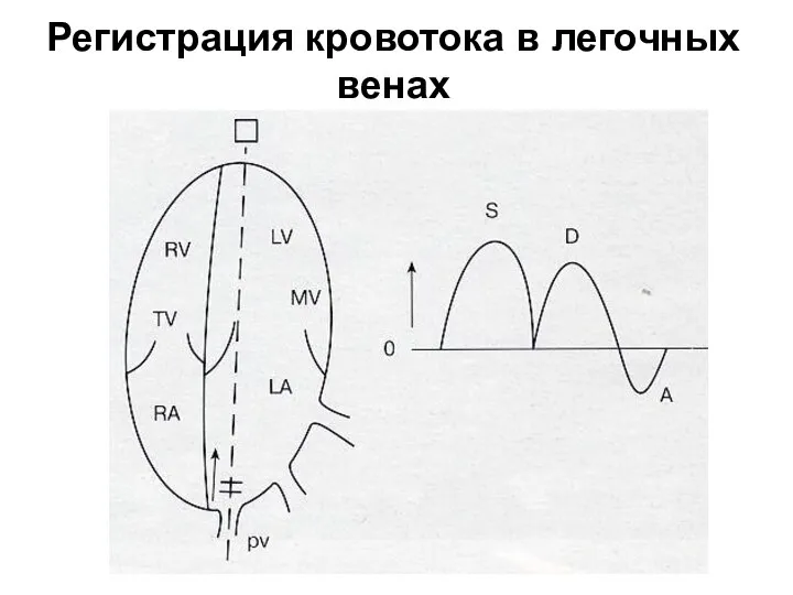 Регистрация кровотока в легочных венах