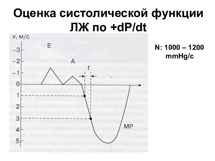 Оценка систолической функции ЛЖ по +dP/dt N: 1000 – 1200 mmHg/c