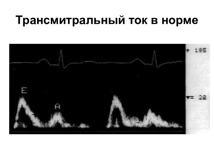 Трансмитральный ток в норме