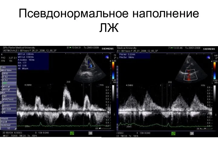 Псевдонормальное наполнение ЛЖ