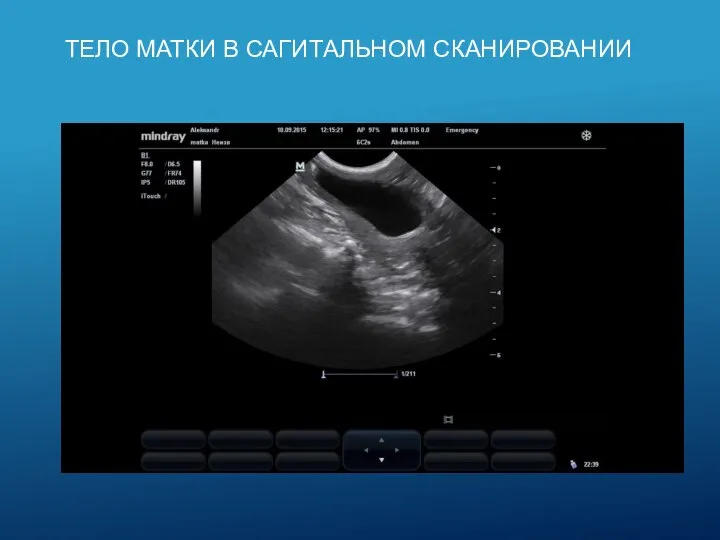 ТЕЛО МАТКИ В САГИТАЛЬНОМ СКАНИРОВАНИИ