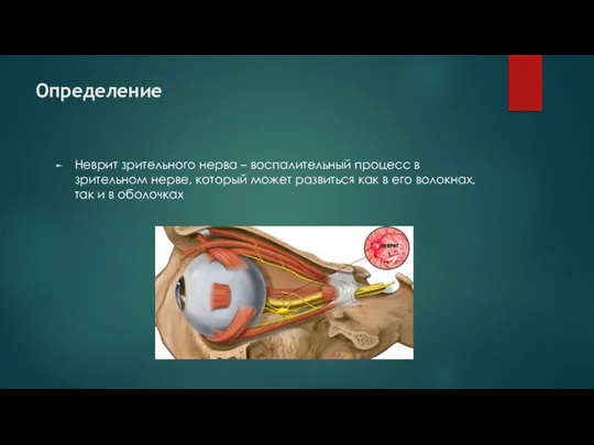 Определение Неврит зрительного нерва – воспалительный процесс в зрительном нерве, который